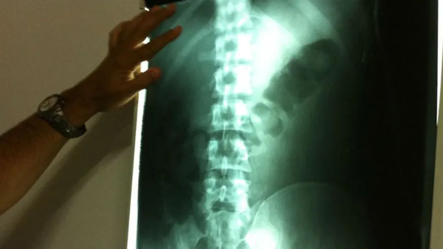 Radiografía que muestra la droga en cápsulas dentro del cuerpo de una mula. Radiografía que muestra la droga en cápsulas dentro del cuerpo de una mula.